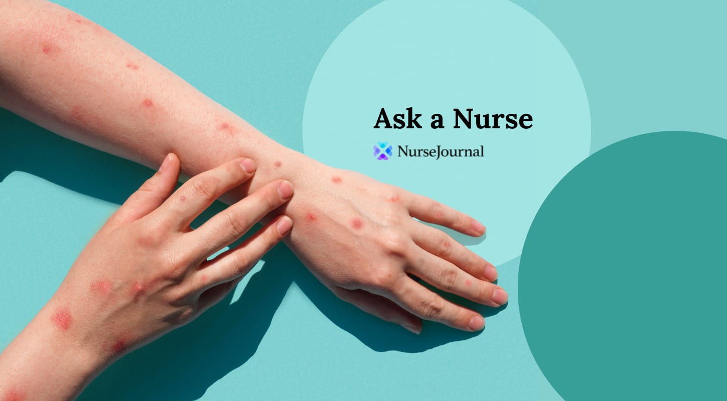 Ask a Nurse: What Is Monkeypox and Should We Be Concerned?